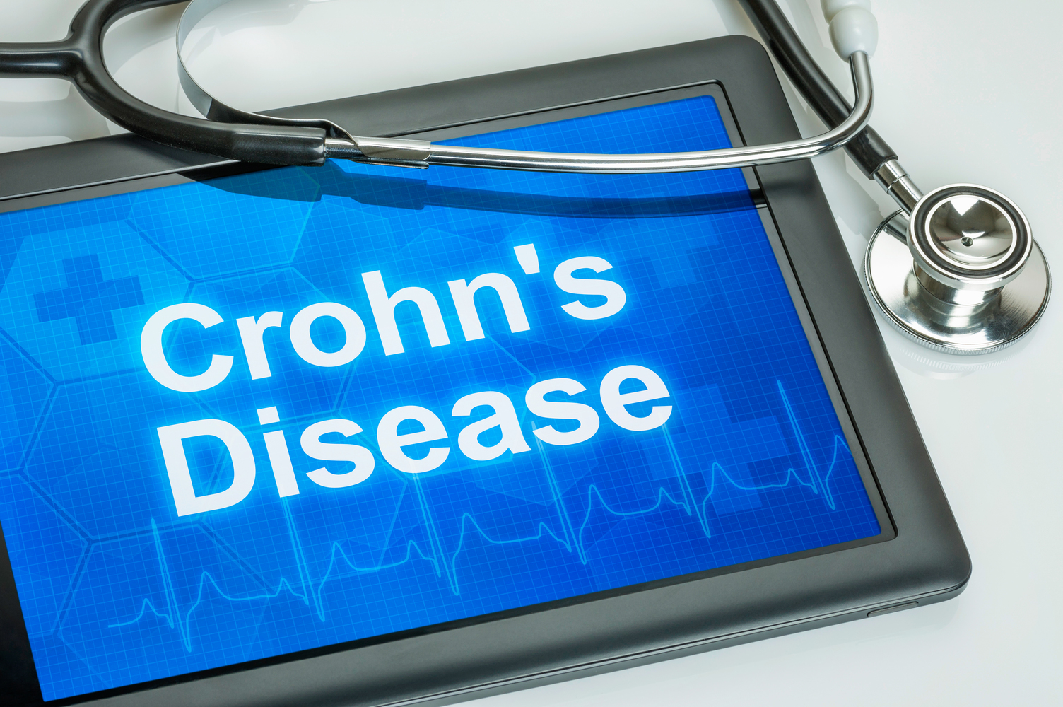 Everything you need to know about Crohn&#8217;s disease